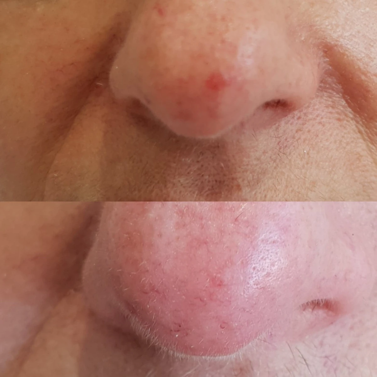 We can provide a long term solution to facial problems such as red flushing (Rosacea), thread veins and red spots in just a few quick and easy treatments.