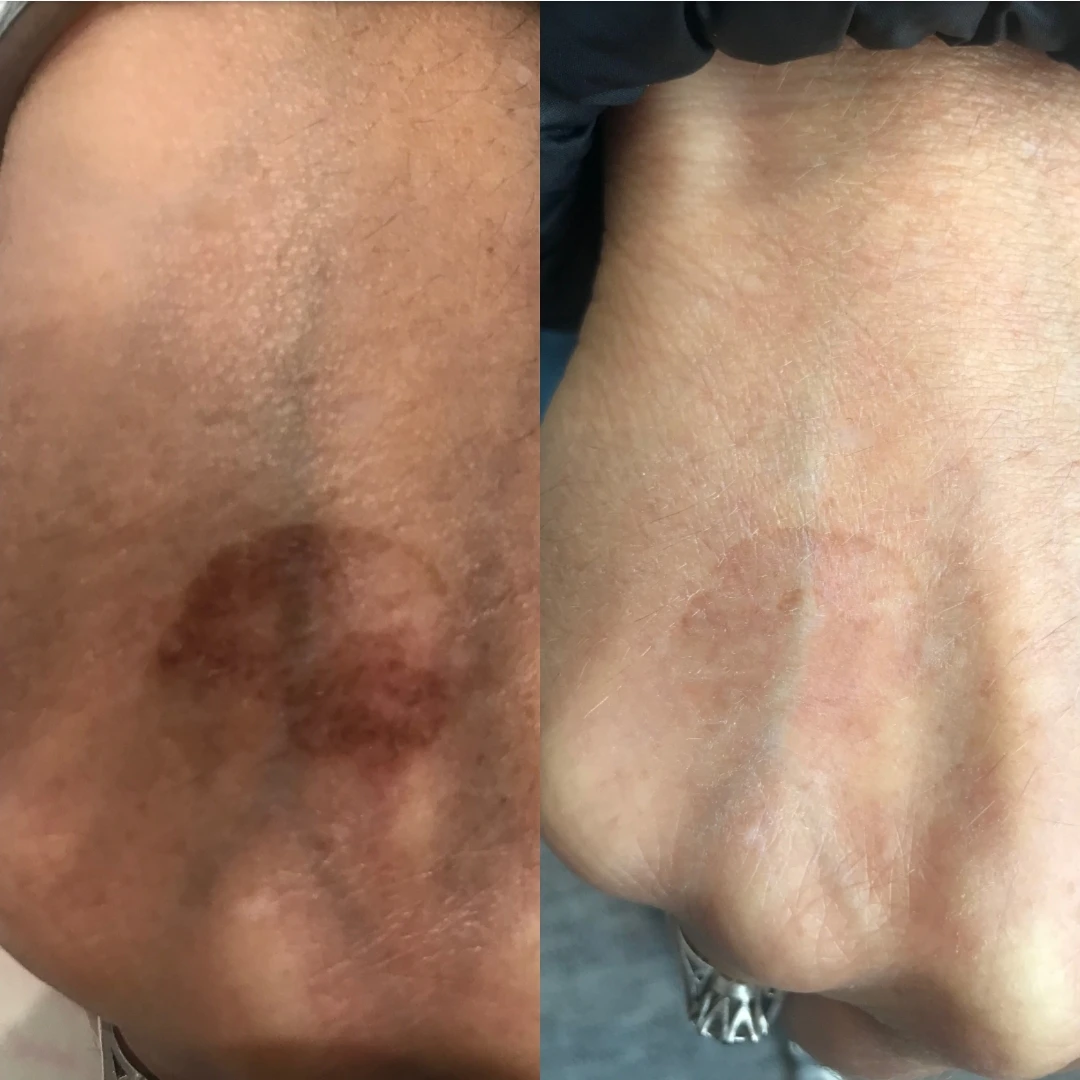 Pigmented lesions such as sun spots and freckles can be successfully removed creating a more flawless, youthful and glowing appearance.